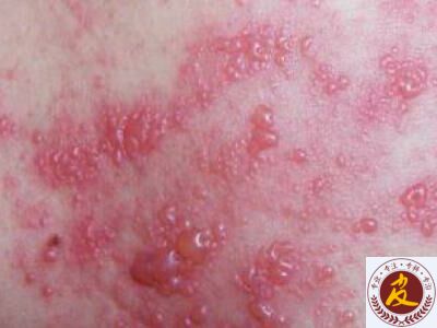 带状疱疹的传染途径 感染过水痘是首因